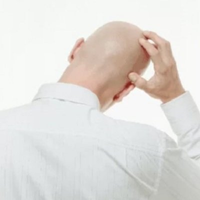 Hair Replacement Systems for Bald Men London UK 1