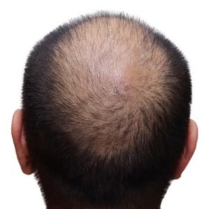Mens hair loss treatments in London Holborn