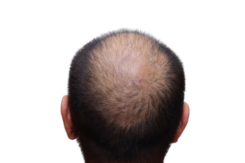 the best hair replacement systems in London at Cochrane Co