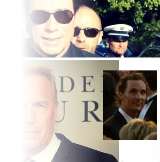 celebrity hair transplants hair replacement in London 1