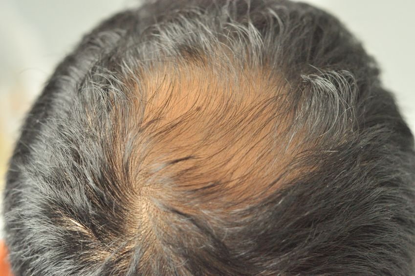 Hair Loss