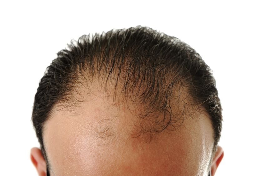 hair loss
