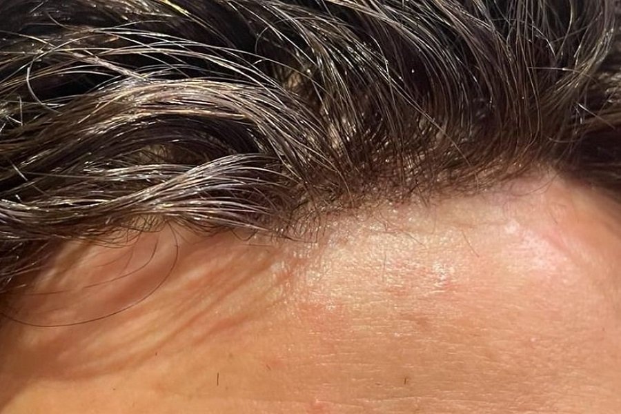 thinning hair solutions