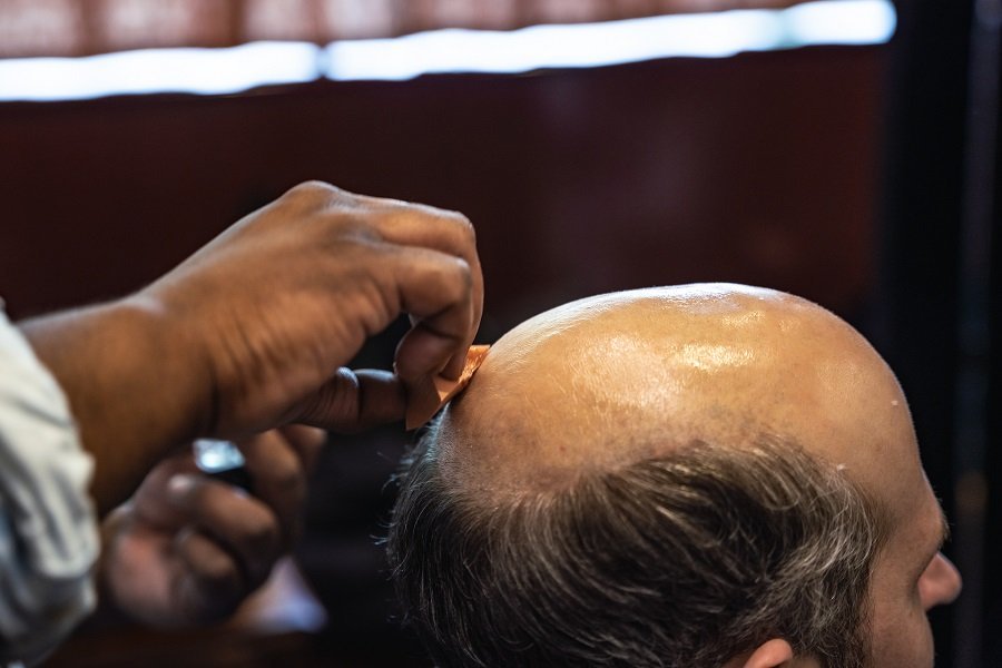 Hair Replacement