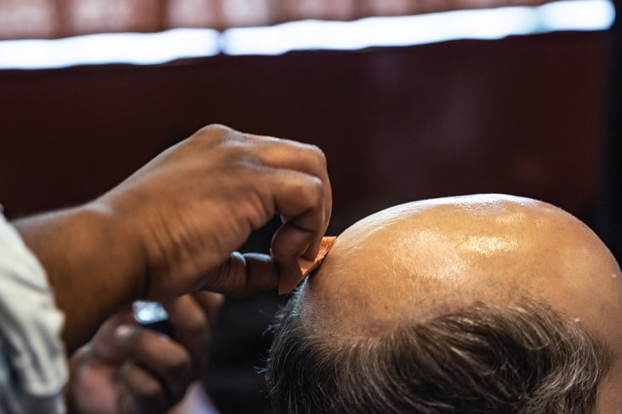 non-surgical hair replacement